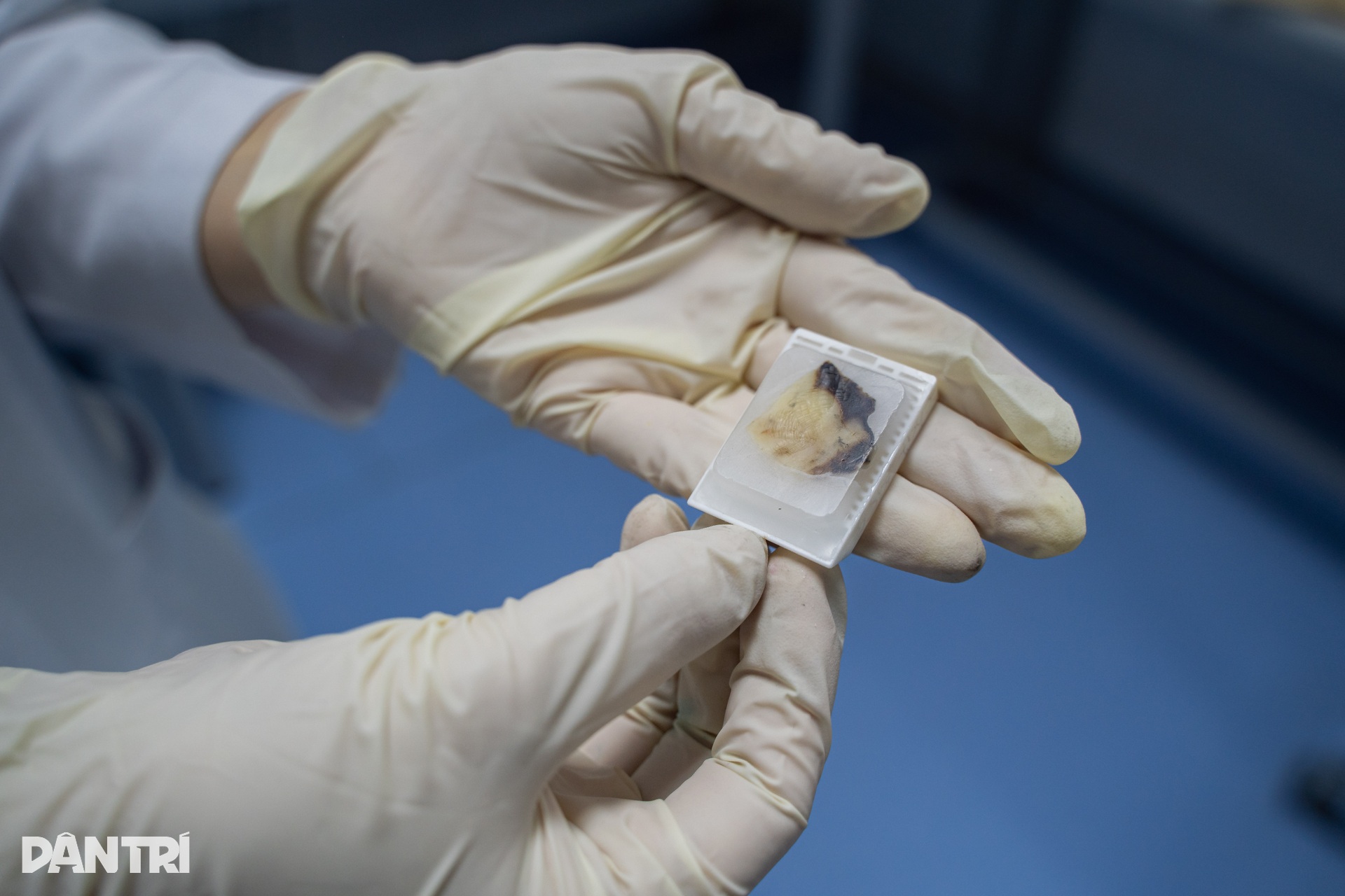 48 giờ truy tìm ADN đột biến, mở hướng điều trị đích cho bệnh nhân ung thư - 2 48 giờ truy tìm ADN đột biến, mở hướng điều trị đích cho bệnh nhân ung thư - 2