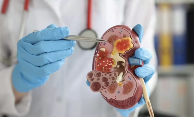 Bác sĩ cảnh báo thói quen phổ biến âm thầm gây hại thận 1 Việc liên tục xử lý nồng độ natri cao khiến hệ thống lọc máu phải làm việc ở cường độ tối đa. Ảnh minh họa: Times of India