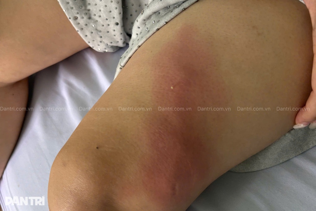 Mất hàng trăm triệu đồng, biến dạng ngực và mông nặng vì tiêm filler “lạ” - 2