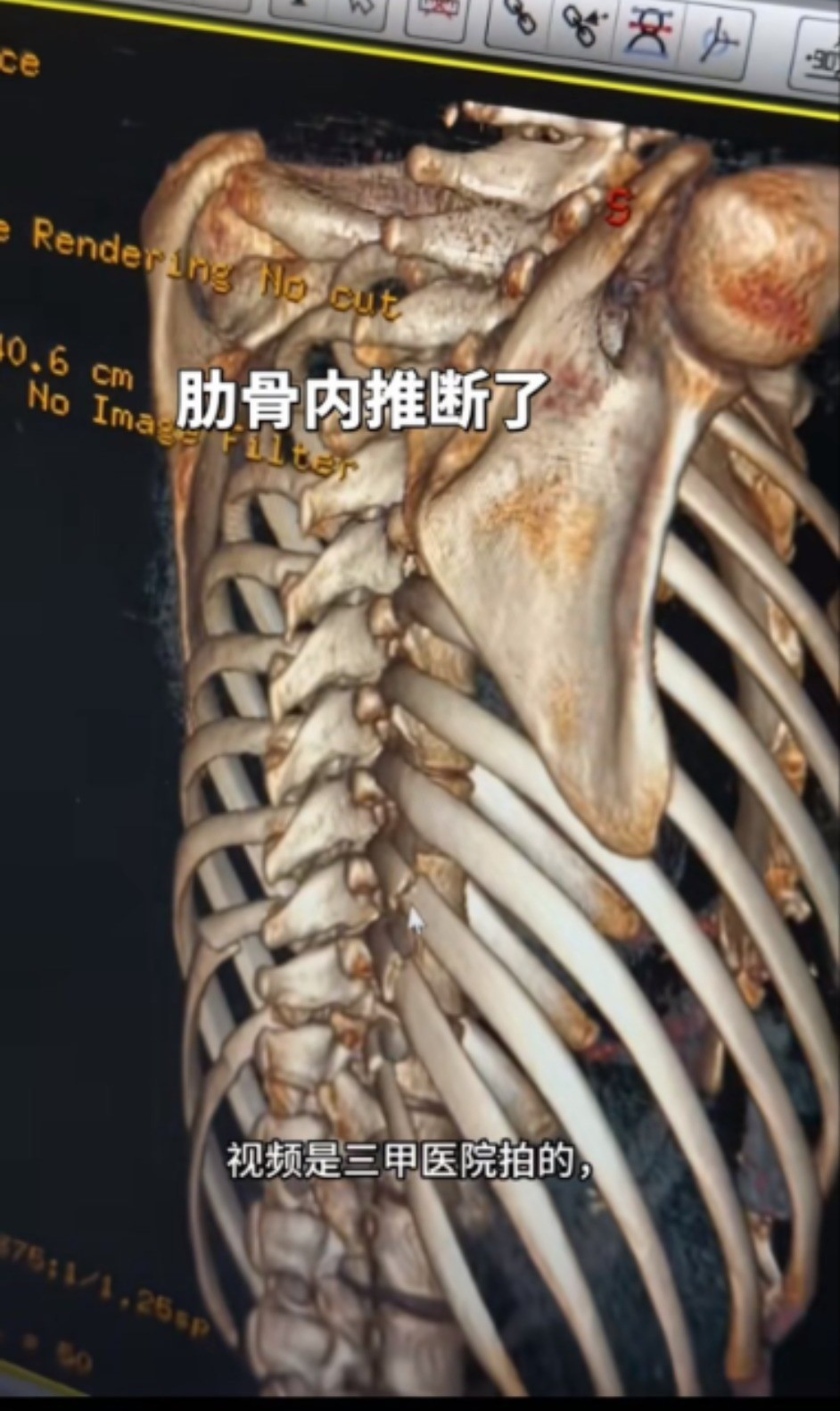 Xu hướng bẻ xương sườn để có vòng eo con kiến- Ảnh 3.