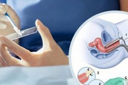 Cách tốt nhất để phát hiện sớm ung thư cổ tử cung