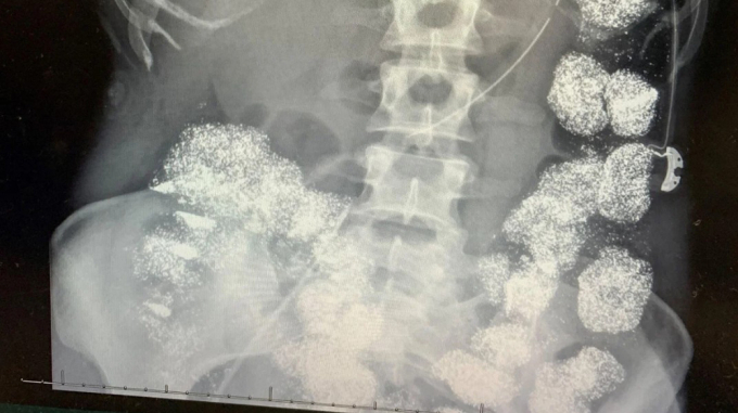Hình ảnh X-quang cho thấy cơ thể Hannah Pettey bị lấp đầy bởi chì. Ảnh: Hartselle Police Department