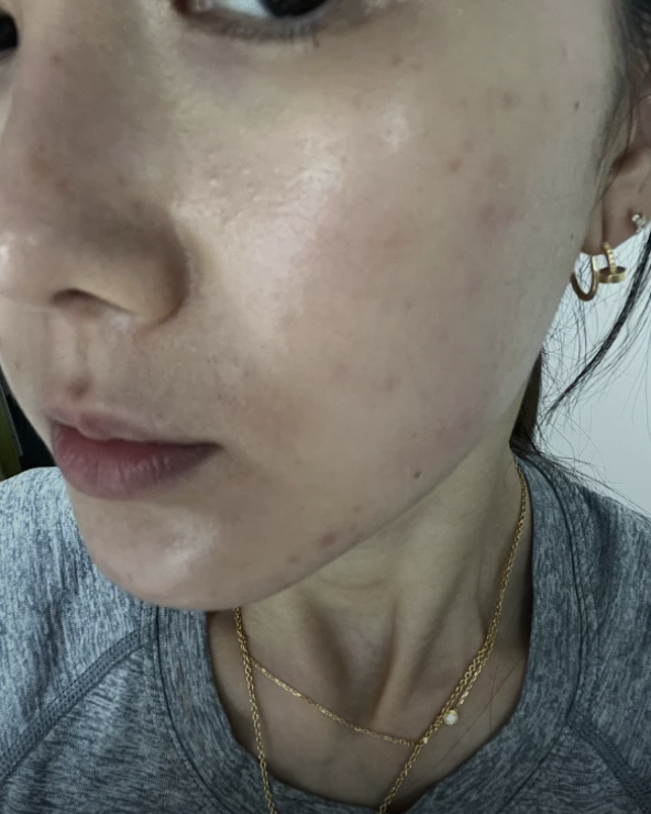 Beauty editor 29 tuổi, da tốt mà vẫn toang vì mụn: Hành trình “cứu” da chỉ với 6 sản phẩm nền tảng- Ảnh 2.