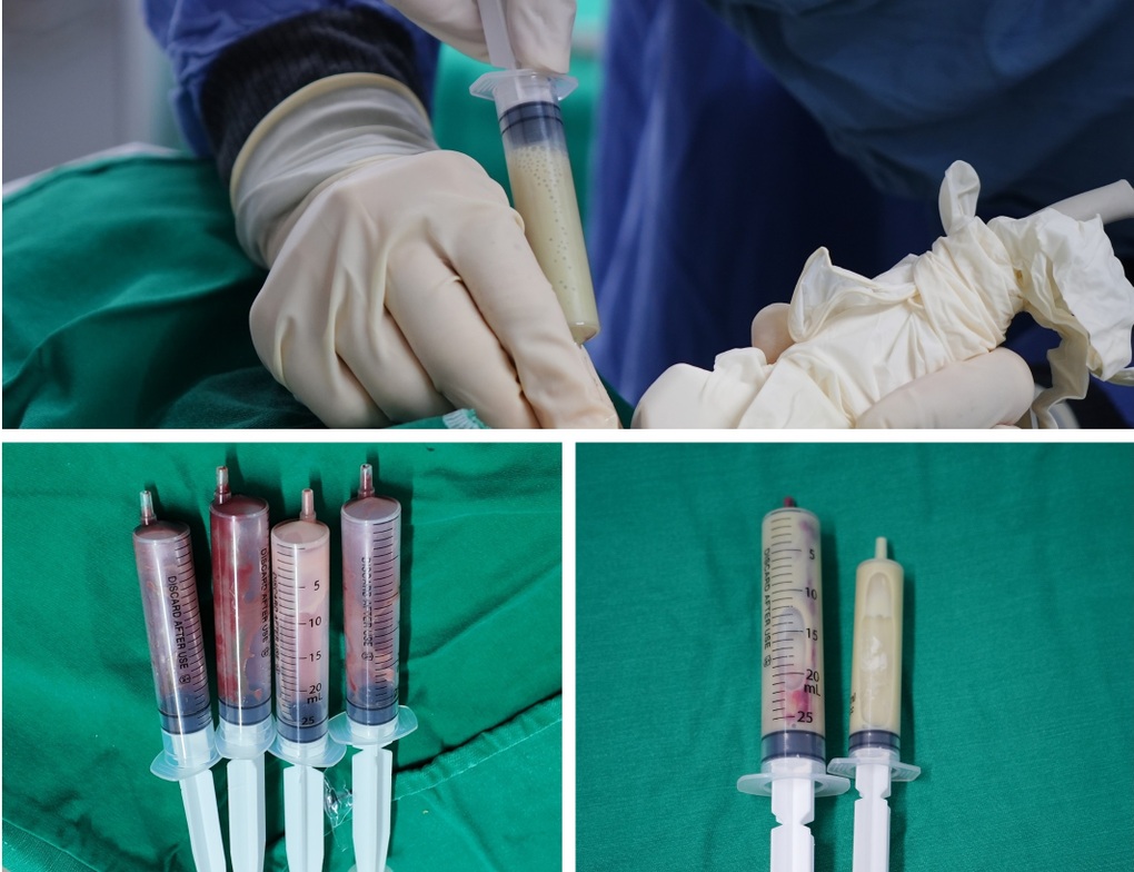 Nguy kịch vì chùm áp xe gan 11cm gây nhiễm khuẩn huyết - 3