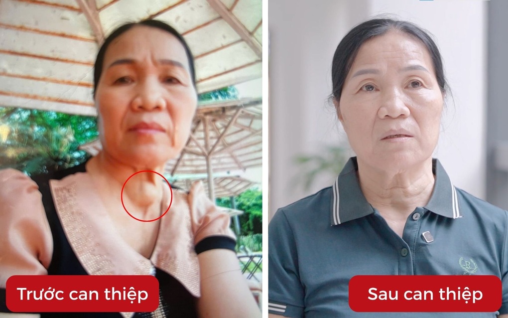 Đốt sóng cao tần RFA u tuyến giáp là gì, có đau không? - 2