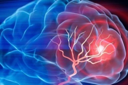 Mỹ phát triển phương pháp trị đột quỵ mới, chỉ cần 1 lần truyền dịch