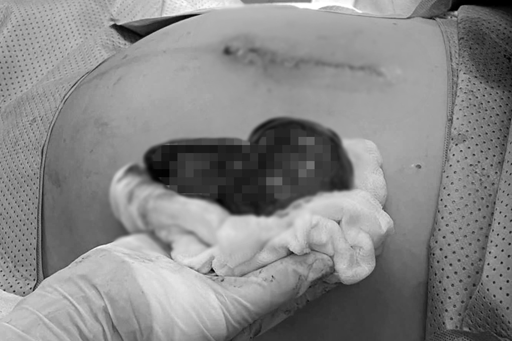 Nhập viện muộn, nhiều phụ nữ ở TPHCM nguy kịch vì u buồng trứng xoắn - 2