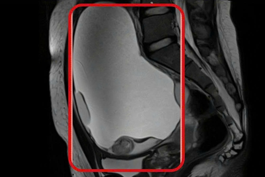 Nhập viện muộn, nhiều phụ nữ ở TPHCM nguy kịch vì u buồng trứng xoắn - 3