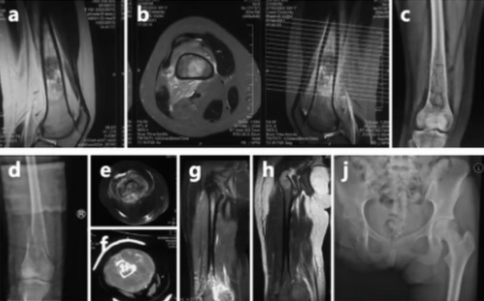 Phim chụp ung thư xương của Thế Vĩ. Ảnh: The Paper