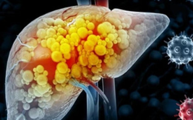 Hai vợ chồng cùng mắc ung thư gan: Cảnh giác 4 loại thực phẩm để lâu trong tủ lạnh 4 Ung thư gan. Ảnh minh họa