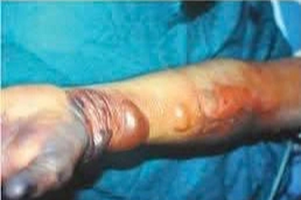 Bị vây cá đâm, người đàn ông nhiễm khuẩn nghiêm trọng - 2