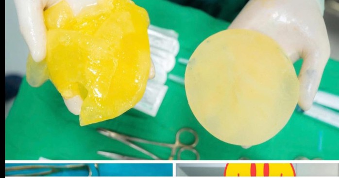 Rất nhiều phụ nữ đã "trùng tu" vòng 1 lo lắng không thể chơi pickleball