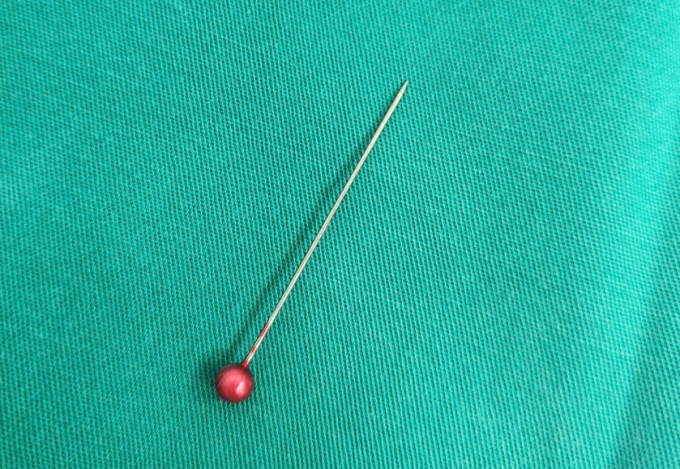 Dị vật được gắp ra ngoài. Ảnh: Bệnh viện cung cấp