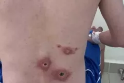 Nam nhân viên văn phòng lở loét toàn thân vì quan hệ tình dục bừa bãi