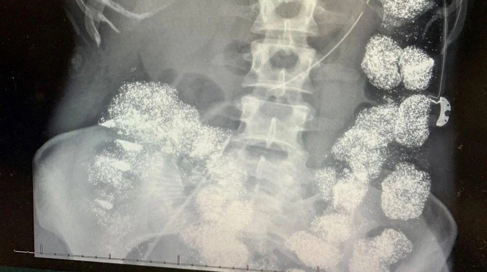 Vụ đầu độc bằng chì trong gia đình bác sĩ: Âm mưu chiếm đoạt tiền bảo hiểm- Ảnh 2.