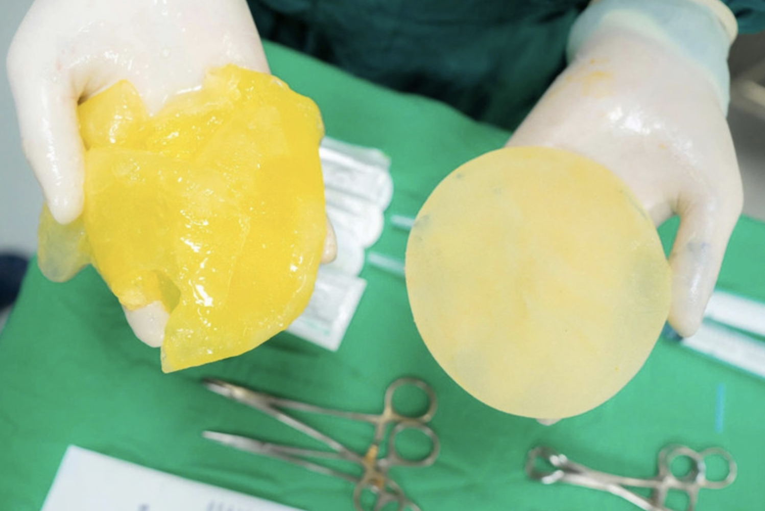 Bác sĩ nói gì về nguy cơ vỡ túi ngực khi chơi pickleball? - Ảnh 1.