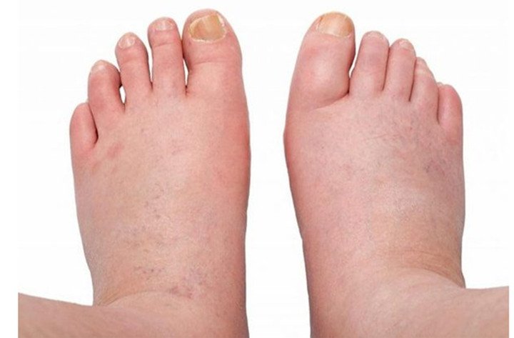 Bàn chân xuất hiện những dấu hiệu này, thận có thể đang kêu cứu 1 Phù chân là dấu hiệu điển hình của bệnh thận (Ảnh: Pharmacity)