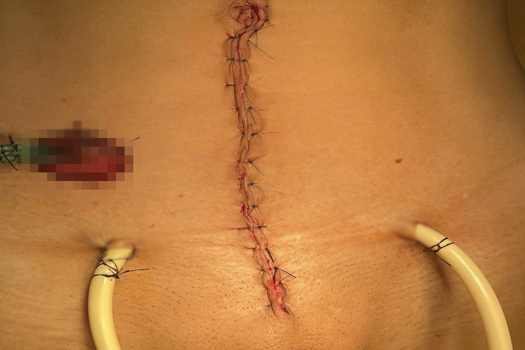 Bệnh nhân tiểu ra máu tươi, nguy kịch: Bác sĩ tiết lộ thói quen tai hại - 2