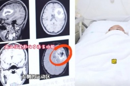 Cô gái bỗng dưng "quên" tiếng Anh: Bác sĩ phát hiện nguyên nhân bất ngờ