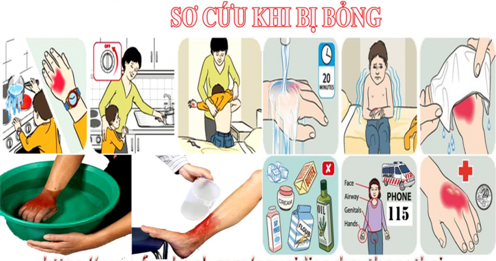 bỏng - Ảnh 1.