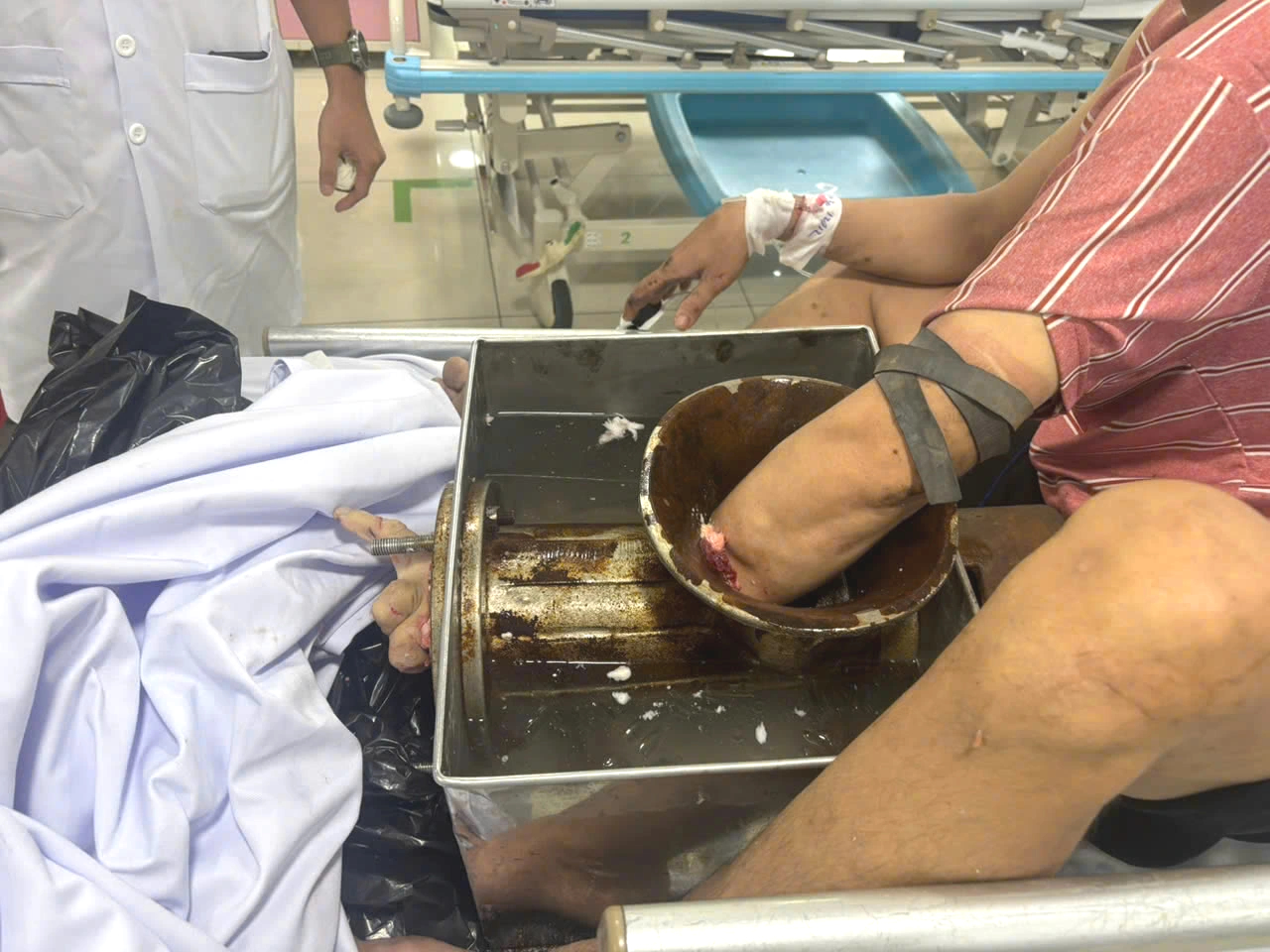 TP.HCM: Bị máy xay thịt 'nuốt chửng' tay, phải đưa cả người và máy vào phòng mổ- Ảnh 1.