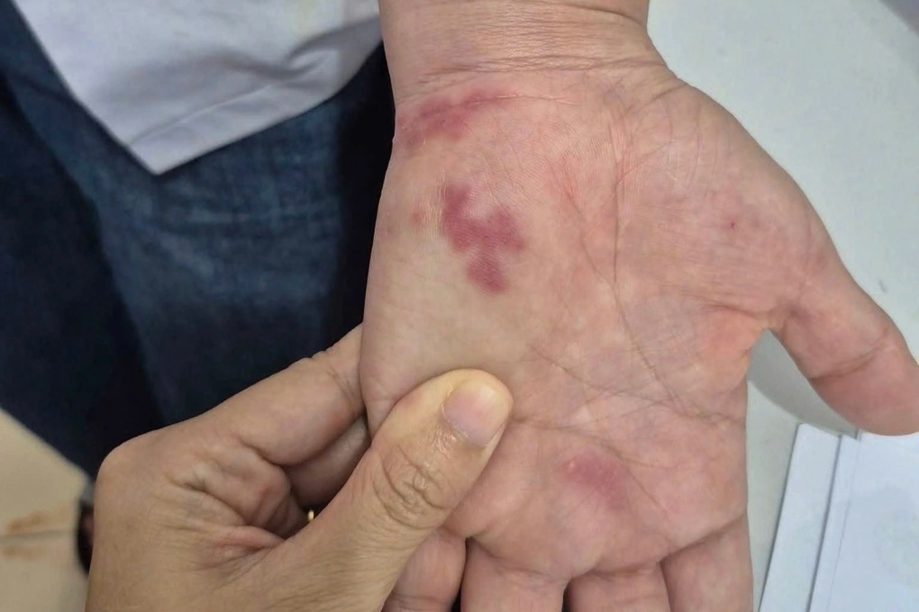 Bị vây cá đâm, người đàn ông nhiễm khuẩn nghiêm trọng - 1