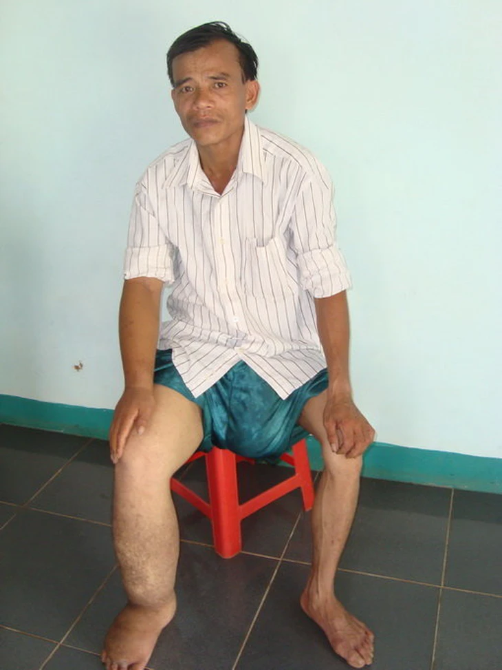 Bỗng dưng bàn tay, bàn chân to ra: Có thể là dấu hiệu bệnh lý nguy hiểm - Ảnh 2.