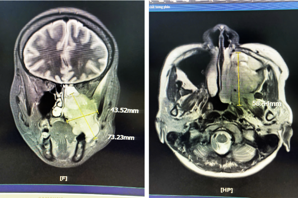 Bỗng phát hiện căn bệnh ung thư quái ác sau khi nghẹt mũi và đau răng - 1