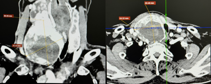 Ảnh chụp CT cho thấy bướu giáp kích thước lớn, chèn ép khí quản. Ảnh: Bệnh viện Đa khoa Tâm Anh