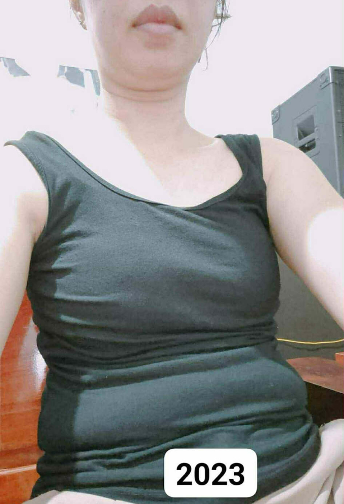 Vòng bụng quá khổ vào năm 2023 của chị Nhung. Ảnh: Nhân vật cung cấp