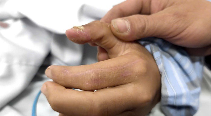 Vết thương ở ngón tay của bệnh nhi do chó cắn. Ảnh: Đặng Thanh