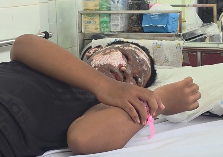 Chơi pháo nổ, bé trai bị tai nạn cháy đen khuôn mặt 1 Khuôn mặt bệnh nhi bị cháy đen, bỏng nặng khi chơi pháo nổ bán trái phép trên mạng xã hội