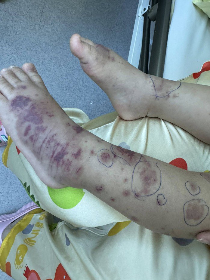 Xuất hiện các nốt ban đỏ là một trong những dấu hiệu của bệnh viêm não mô cầu