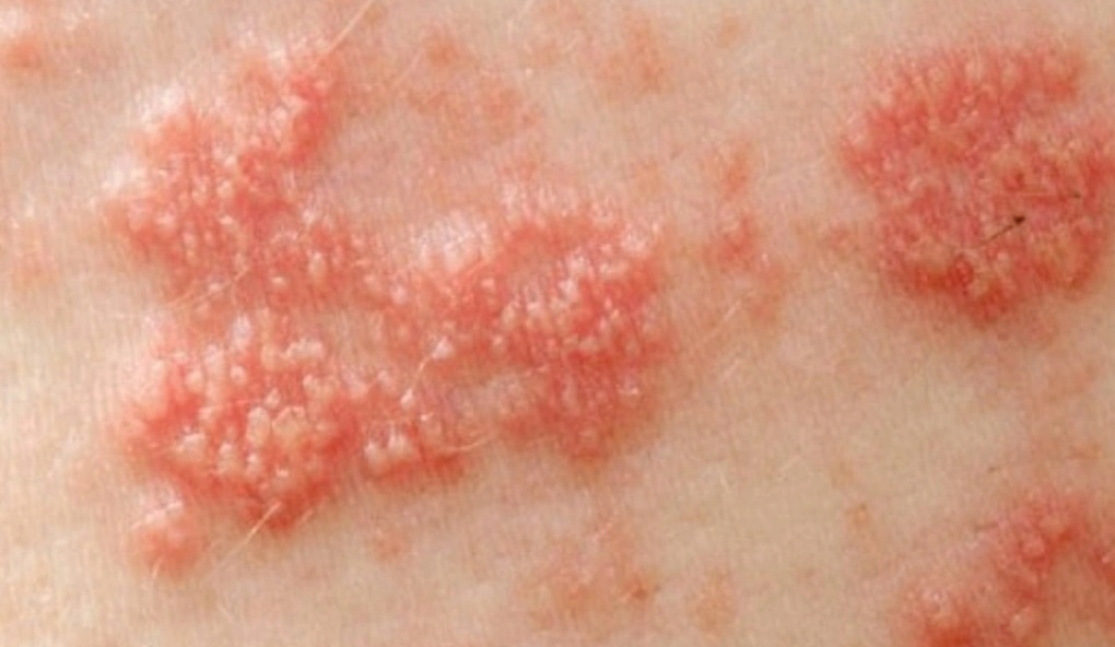 Cơn đau thấu xương sau zona thần kinh ám ảnh người bệnh - 1