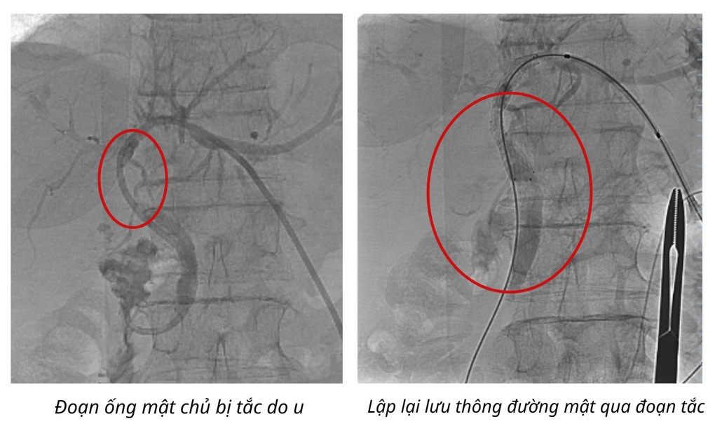 Đặt stent đường mật qua da giảm đau và tắc mật cho bệnh nhân ung thư tụy - 1