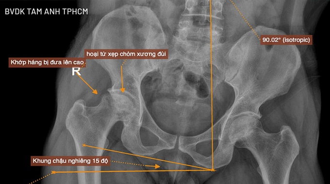 Phim chụp X-quang cho thấy khớp háng bên phải bị đẩy lên cao, khiến xương chậu nghiêng nhiều. Ảnh: Bệnh viện Đa khoa Tâm Anh