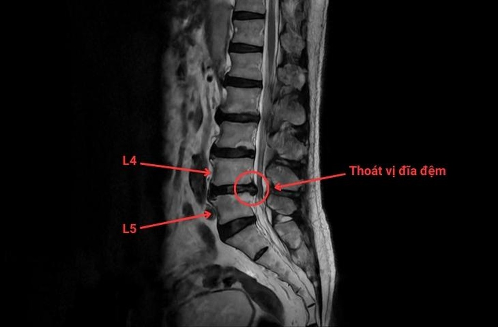 Điều trị giảm đau thoát vị đĩa đệm, không phẫu thuật - 1