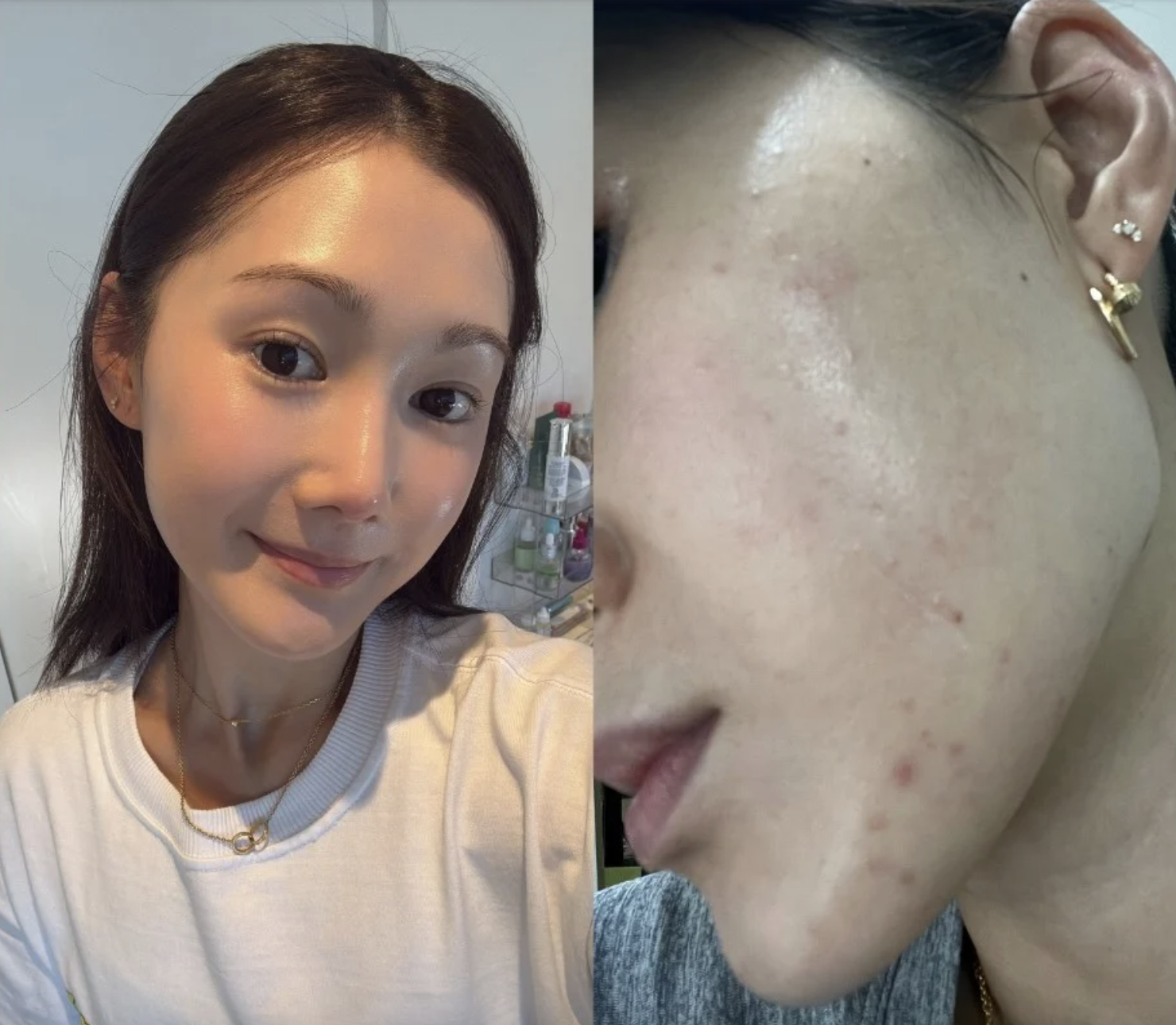 Beauty editor 29 tuổi, da tốt mà vẫn toang vì mụn: Hành trình “cứu” da chỉ với 6 sản phẩm nền tảng- Ảnh 1.