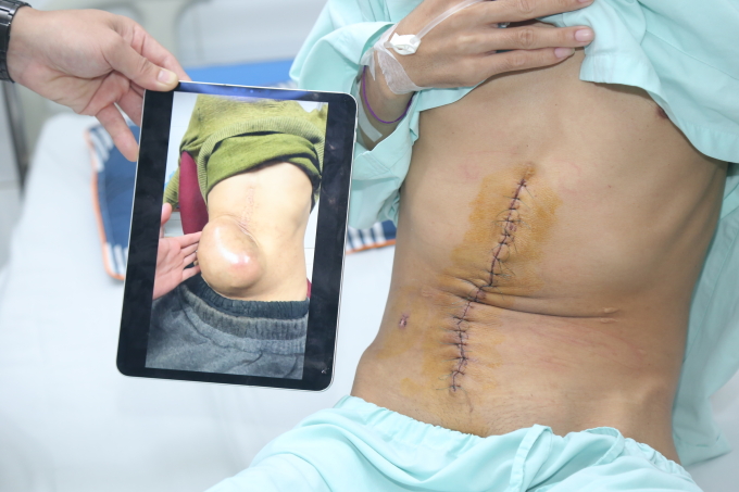 Ung thư gan di căn thành bụng. Ảnh: Bệnh viện cung cấp