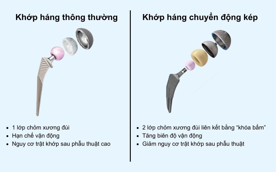 Khớp háng nhân tạo chuyển động kép thế hệ mới - giảm 93% nguy cơ trật khớp 1 So sánh cấu tạo khớp háng nhân tạo thường và khớp háng nhân tạo chuyển động kép
