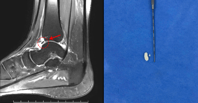Mảnh xương, sụn rời trong khớp người bệnh trên phim chụp MRI (trái) và sau khi được phẫu thuật loại bỏ (phải). Ảnh: Bệnh viện Đa khoa Tâm Anh