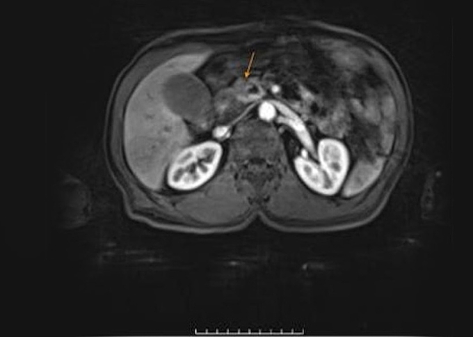 Tổn thương bất thường ở vùng đầu tụy trên ảnh CT. Ảnh Bệnh viện Đa khoa Tâm Anh