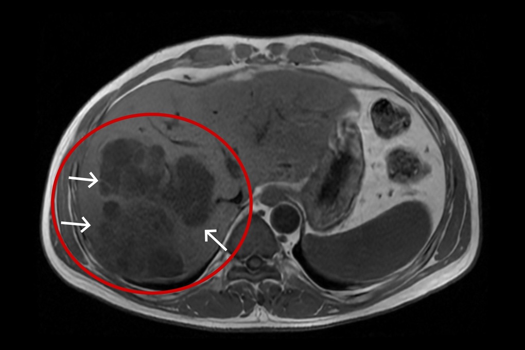 Nguy kịch vì chùm áp xe gan 11cm gây nhiễm khuẩn huyết - 1