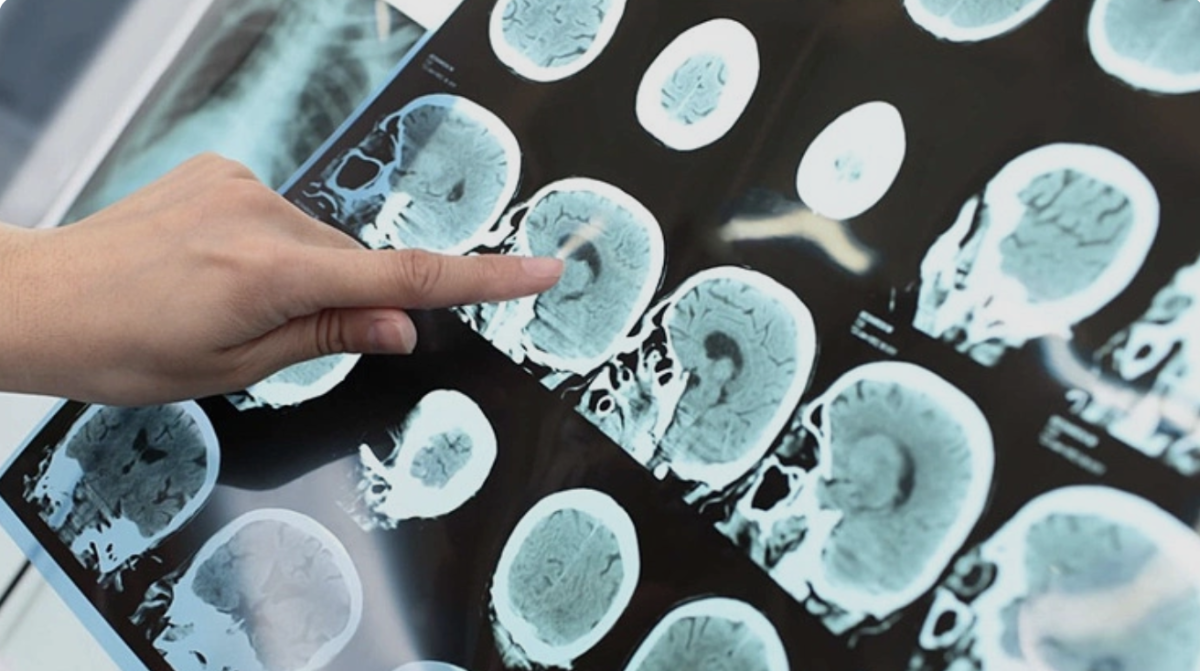 Những 'cú sốc nhiệt' kích hoạt đột quỵ khi trời lạnh 1 Nhung cu soc nhiet kich hoat dot quy khi troi