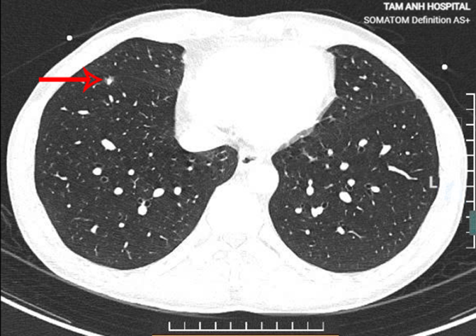 Nốt phổi nguy cơ cao của anh Thắng trên phim chụp CT liều thấp. Ảnh: Bệnh viện Đa khoa Tâm Anh