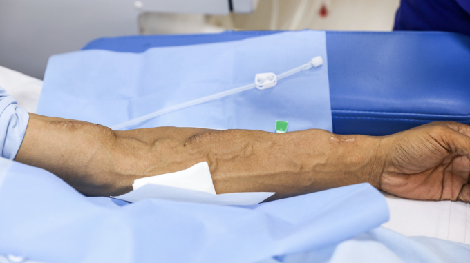 Bệnh nhân chạy thận nhân tạo tại Bệnh viện Thống Nhất, TP HCM. Ảnh: Phùng Tiên