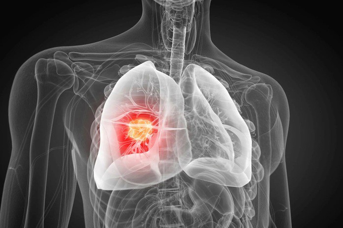 Phát hiện nguyên nhân gây ung thư phổi chưa từng biết 1 Một cơ chế viêm nhiễm chưa từng được biết đến trước đây có thể là thủ phạm khiến một loại ung thư phổi trở nên nguy hiểm hơn - Ảnh minh họa: SCITECH DAILY
