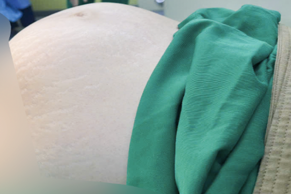 Phát hiện u xơ nhưng không khám định kỳ, người phụ nữ phải cắt bỏ tử cung - 1