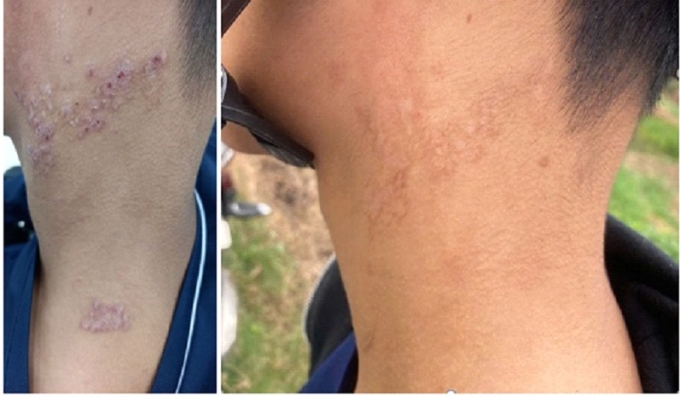 Hình ảnh vết tổn thương trước và sau điều trị. Ảnh: Bệnh viện cung cấp