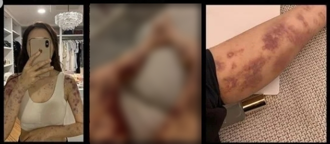 Sao nữ xinh như tiên tỉnh dậy hoảng loạn thấy toàn thân bầm tím sau khi tiêm thuốc bổ tại bệnh viện- Ảnh 2.